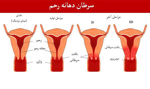 موارد نگران کننده سرطان رحم