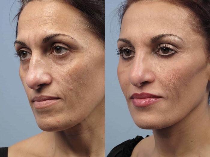 آیا می دانید که شیوه ی درمانی به کمک لیزر فراکشنال به چه صورت عمل می نماید؟