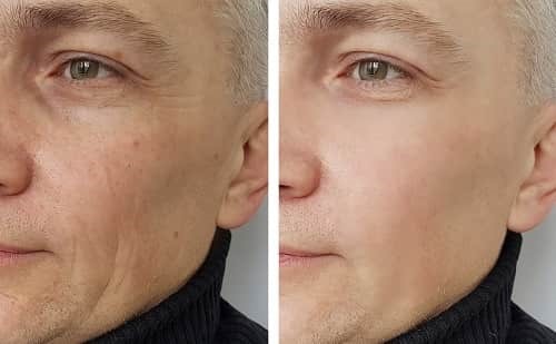 مقایسه ماندگاری زاویه سازی صورت با چربی نسبت به روش های دیگر