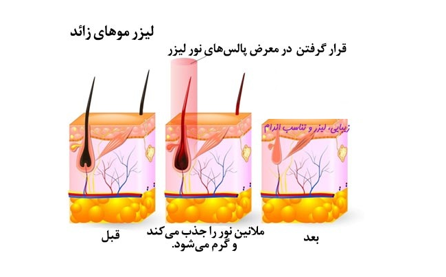 طول موج لیزر الکساندرایت