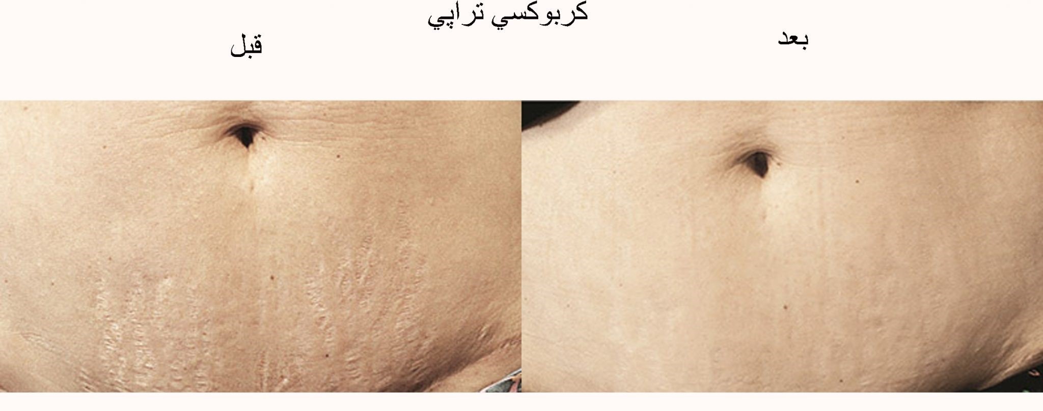 گاز به یک سوزن ریز وارد می شود