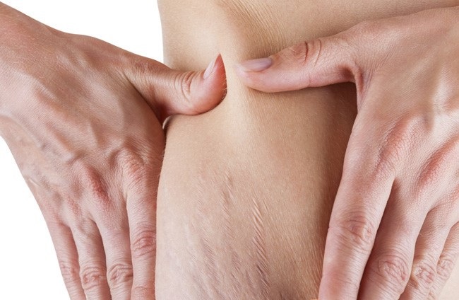 چه کسی کاندیدای خوبی برای لیزر ترک شکم است؟