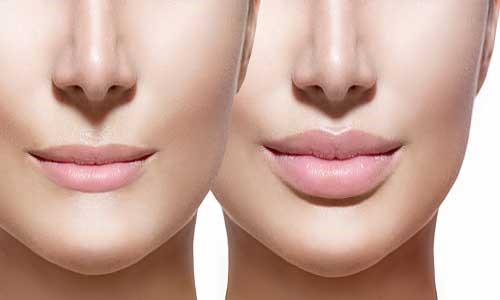 ماندگاری چربی تزریق شده برای زاویه سازی صورت