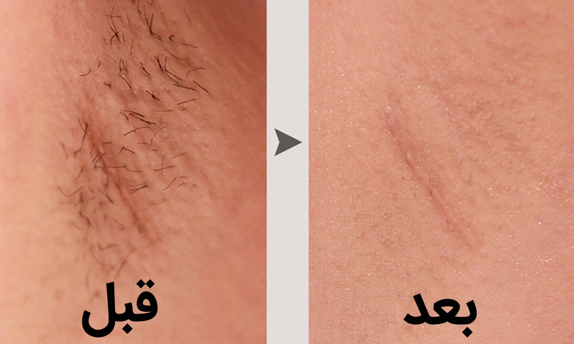 از بین بردن موهای زائد زیر بغل به وسیله ی لیزر چگونه انجام می شود؟