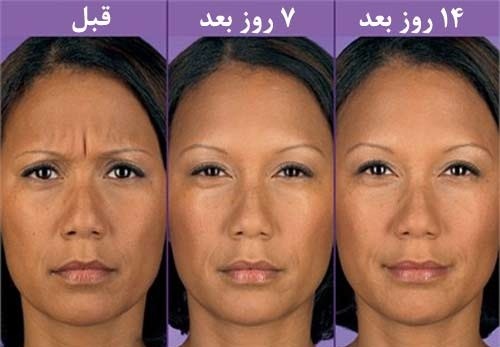 ویژگی اسید هیالورونیک به واسطه خاصیت آب دوست بودن آن است
