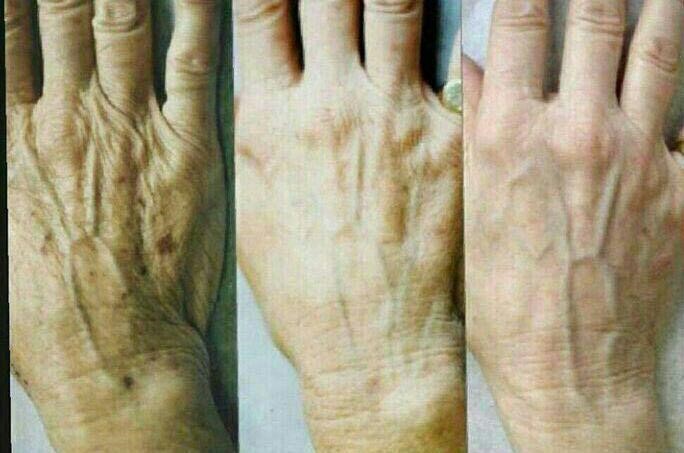 تاثیر کربوکسی تراپی بر پوست دست ها به چه میزان است؟