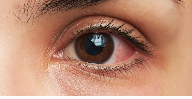 کربوکسی تراپی ارزان در چه مواقعی صورت می گیرد؟