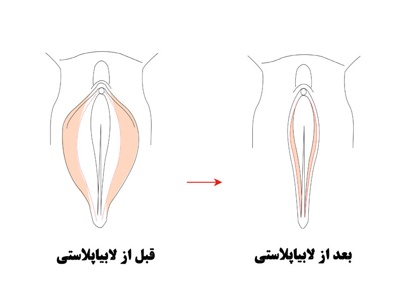 نحوه انجام لابیاپلاستی با لیزر مونالیزا تاچ چگونه است؟