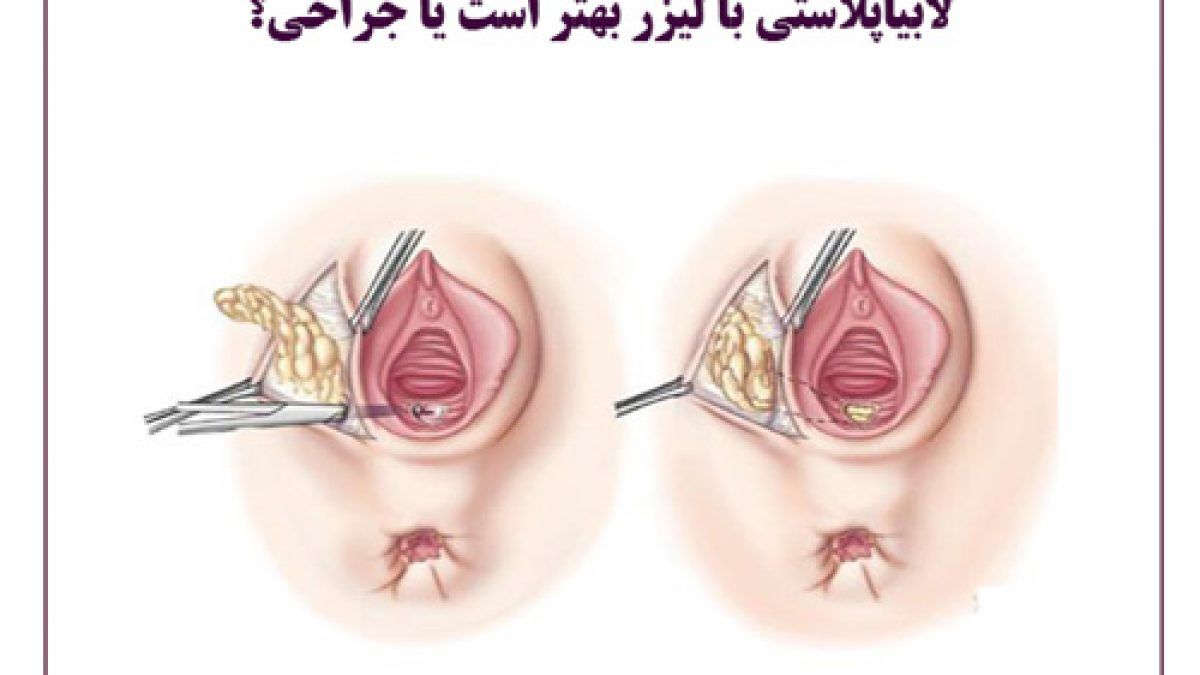 لابیاپلاستی با لیزر مونالیزا تاچ