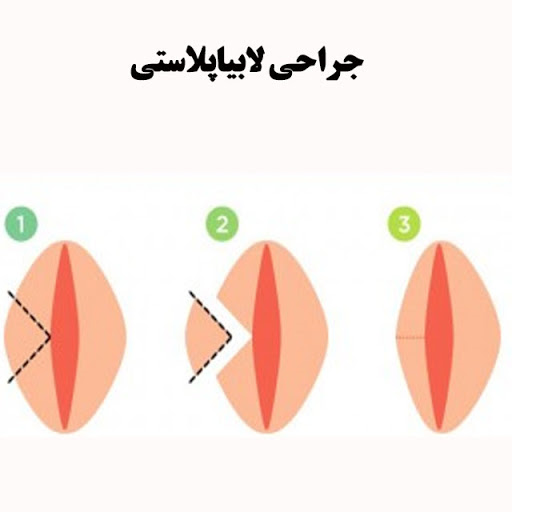مراقبت های بعد از انجام عمل لابیاپلاستی با لیزر مونالیزا تاچ چیست؟