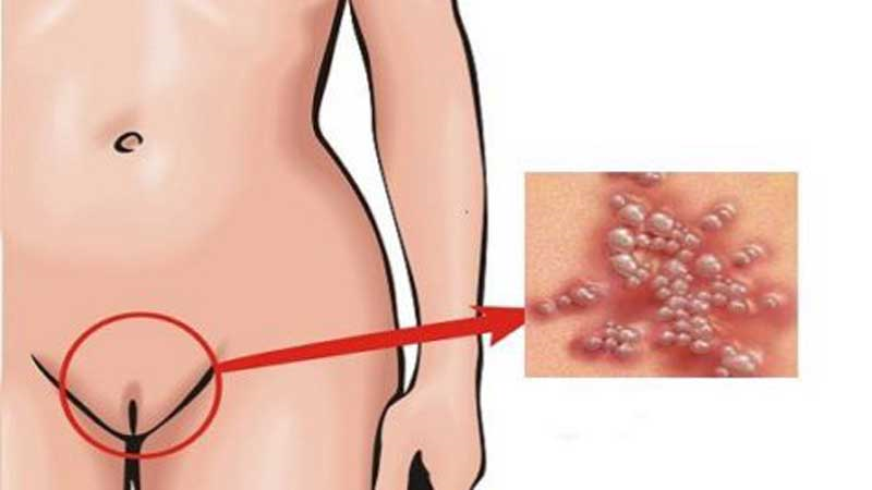 مهم ترین علائم به وجود آمدن زگیل تناسلی چیست؟