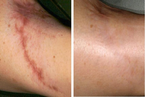 کربوکسی تراپی برای جای اسکار مشابه مزوتراپی است