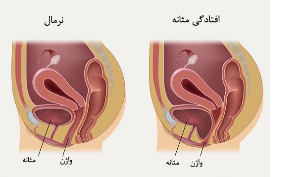 چکه کردن ادرار