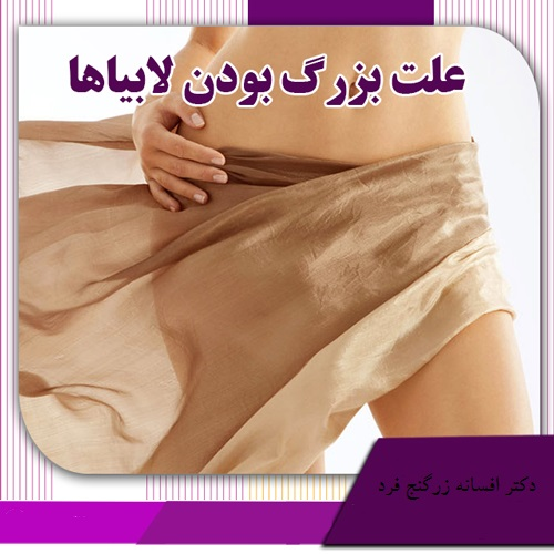 WEDGE techniqe یا وج تکنیک
