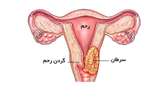 به وجود آوردن مشکلات بارداری