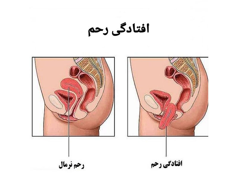 در برخی مواقع ممکن است افراد زایمان ‌های خیلی سختی را تجربه کرده باشند