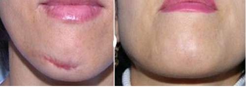 کربوکسی تراپی یک روش نسبتاً بی خطر است