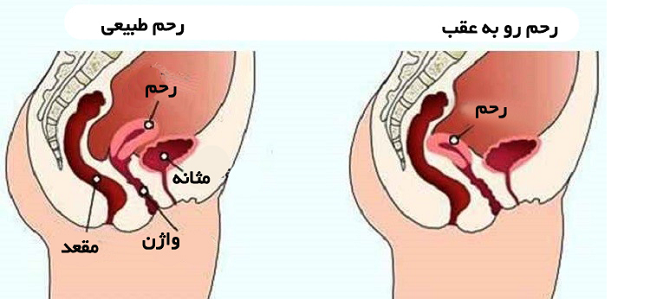 محبوس شدن رحم