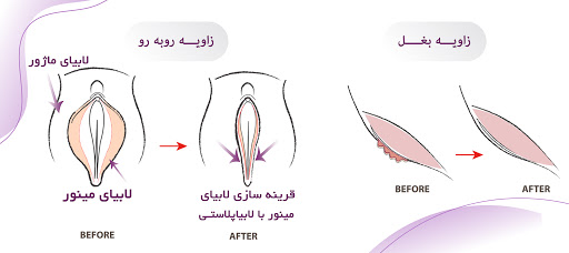 مهم‌ترین عمل زیبایی واژن برای بانوان، لابیاپلاستی می ‌باشد