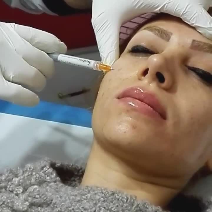 یکی از مزیت های روش تزریق ژل به گونه در مقابل دیگر روش های زیبایی