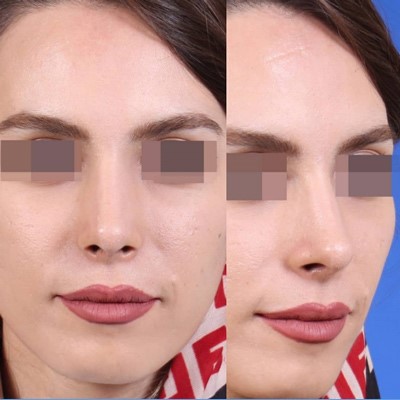 یکی از اقدام های موثر و مهم بعد از اقدام به تزریق ژل گونه