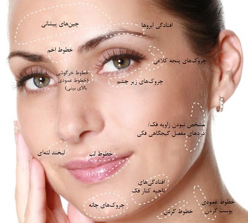 تزریق بوتاکس: