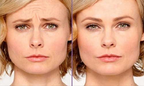 آیا منظور از تزریق بوتاکس، همان ژل و یا تزریق آن می باشد؟