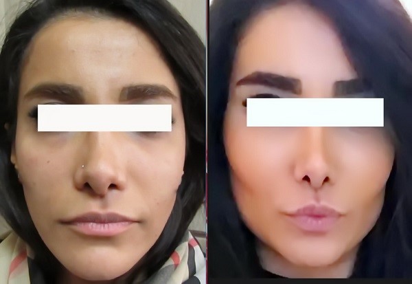 زاویه سازی صورت از چه سنی
