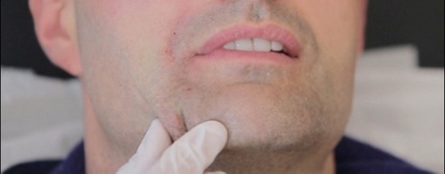 قیمت زاویه سازی صورت مردان به چه صورت تعیین می شود و به چه عامل هایی وابسته است؟