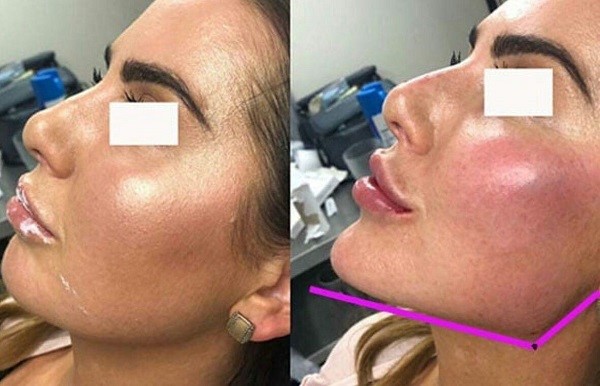 زاویه دار کردن صورت از راه تزریق کردن بوتاکس:
