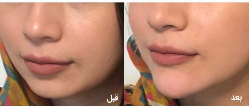 زاویه دار کردن صورت از راه جراحی: