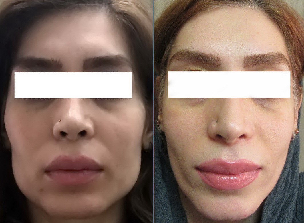 آیا می دانید که زاویه دار کردن صورت چیست و به چه دلیل انجام می شود؟