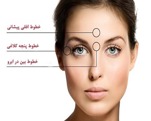 بعد از بوتاکس چه نکاتی را باید رعایت کرد