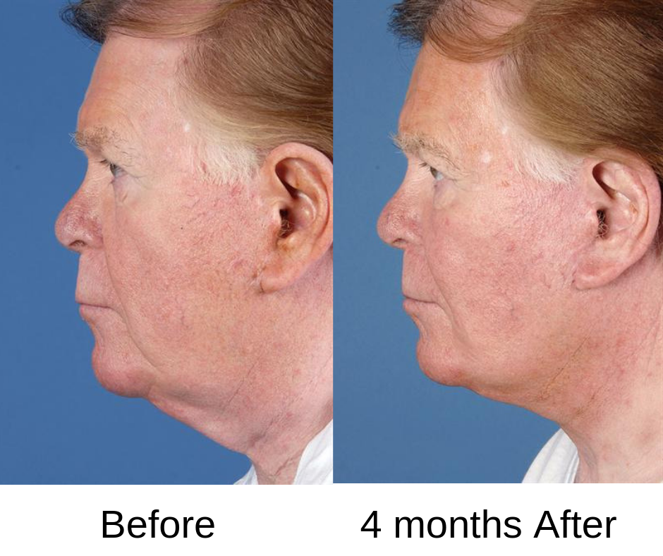 در هنگام انجام زاویه سازی صورت، فرد مراجعه کننده می بایست به چه نکته هایی دقت داشته باشد؟