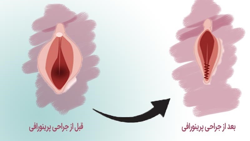 آیا عمل زیبایی پرینورافی واژن نیاز به بیهوشی دارد؟