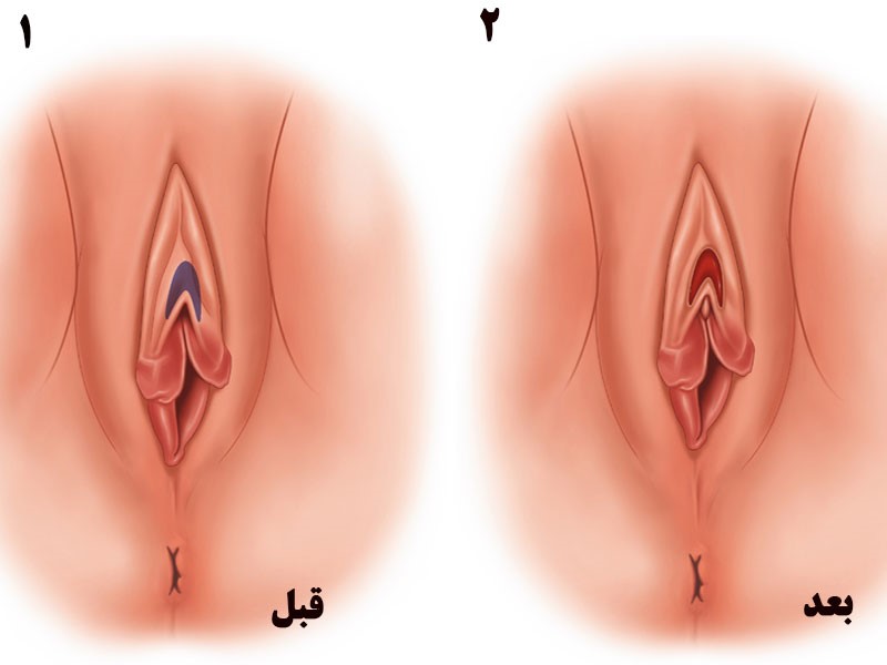 ماندگاری اثر واژینوپلاستی