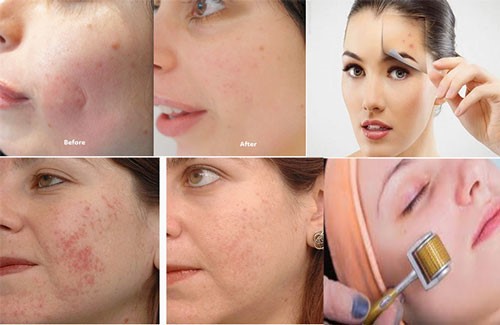 آیا در زمینه ی چگونگی اجرای تکنیک میکرونیدلینگ اطلاعاتی دارید؟