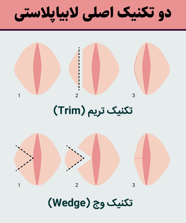 آیا عمل زیبایی لابیاپلاستی واژن نیاز به بیهوشی دارد؟