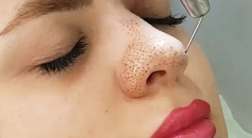 مقایسه پلاسما جت و جراحی