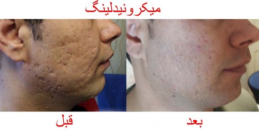 بهتر است در این زمینه و مباحث مرتبط با میکرونیدلینگ تحقیقات مناسبی را صورت دهید