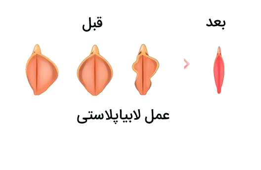 لابیاپلاستی با لیزر:
