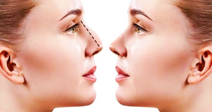 هزینه پلاسما جت بینی چقدر است؟
