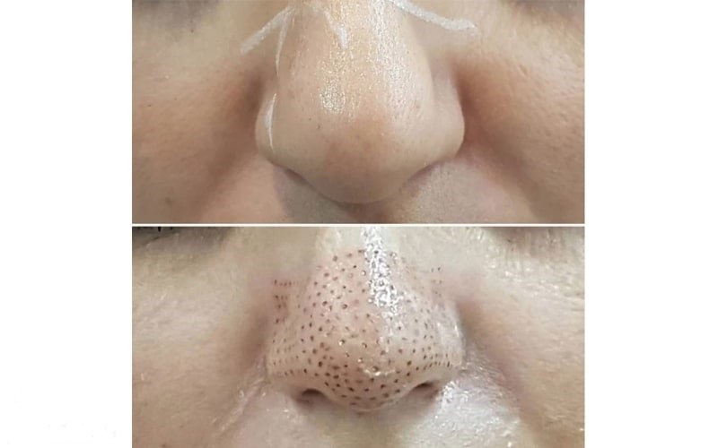 استفاده از سیستم های فشار کم پلاسما جت