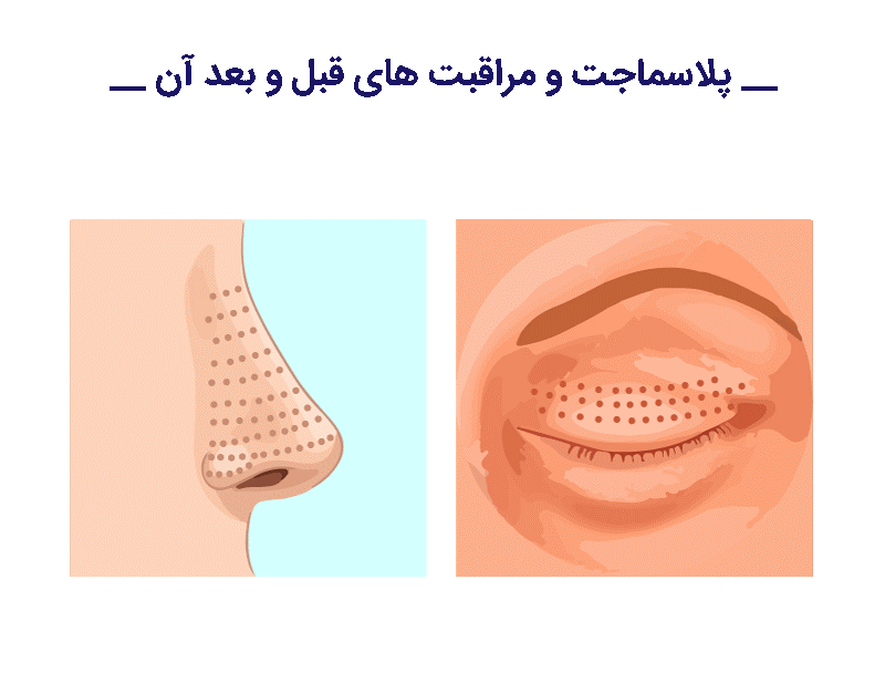 این در درجه اول به این دلیل است که منابع پلاسما سرد به تجهیزات فنی پیچیده و کارایی اقتصادی پایین نیاز دارند.