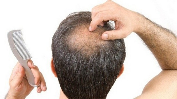 چه افرادی می‌توانند از تزریق فیلر مو استفاده کنند؟