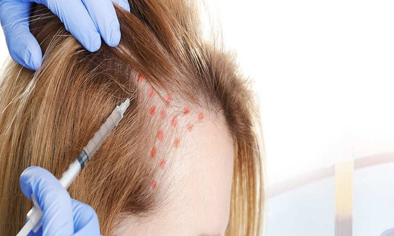 چه افرادی کاندید مناسب برای استفاده از مزوتراپی می‌باشند؟