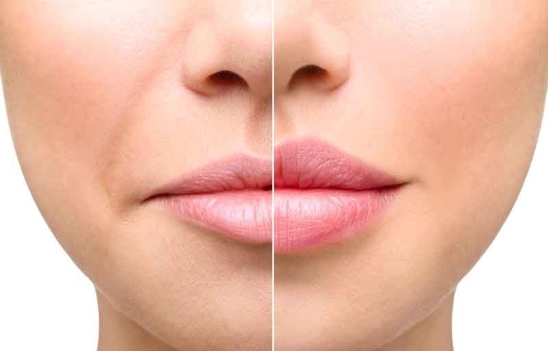آماده سازی ژل و لب برای تزریق