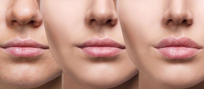 تزریق ژل به لب بهتر است یا چربی