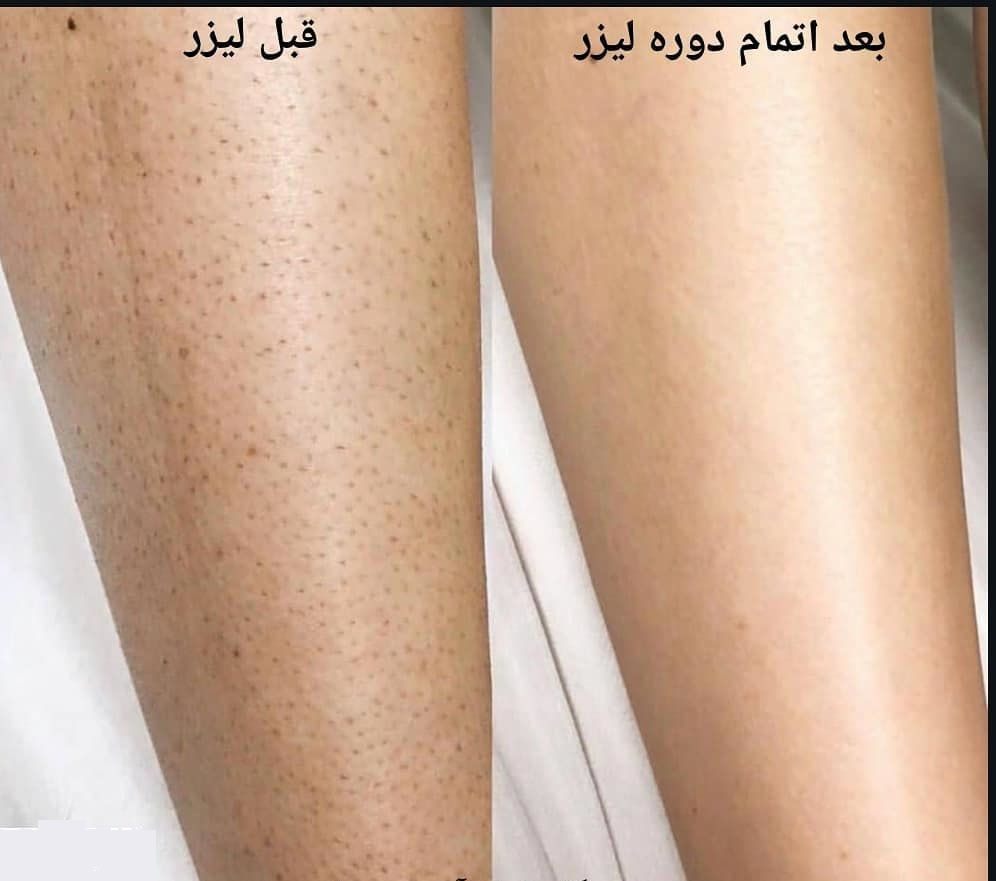 موی ترمینال