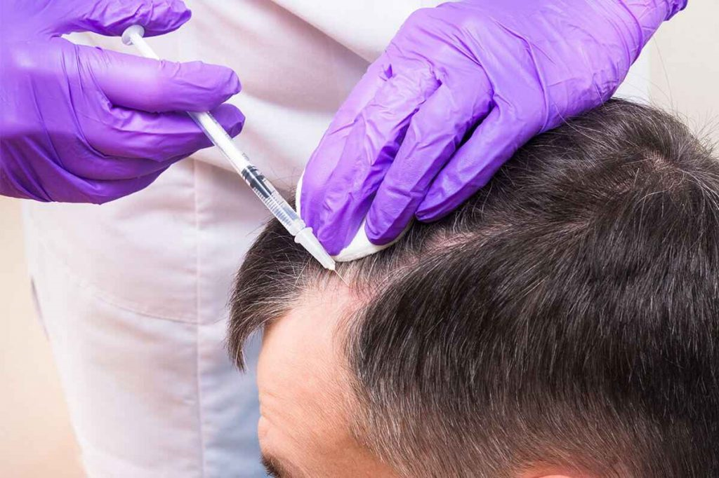 تفاوت فیلر مو با مزوتراپی